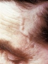 Treating Giant Cell Arteritis to Avoid Complications