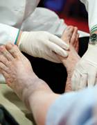 Study illustrates why some wounds escape amputation Study illustrates why some wounds escape amputation