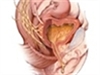 Urinary incontinence in the older female population