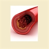 When Statins Are Not Enough Residual Risk, Hyper TG Dyslipidemias, FH  LDL Apheresis