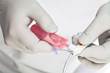 Kimberly-Clark introduces subglottic suctioning endotracheal tube Kimberly-Clark introduces subglottic suctioning endotracheal tube