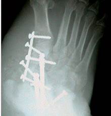 Foot casts may limit harm caused by neuroarthropathy Foot casts may limit harm caused by neuroarthropathy