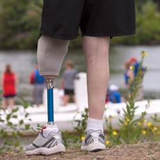 There are more than 80,000 lower extremity amputations annually on diabetic patients in the United States. There are more than 80,000 lower extremity amputations annually on diabetic patients in the United States.
