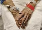Hospital IV therapy may drain Medicare Part D, news analysis finds Hospital IV therapy may drain Medicare Part D, news analysis finds