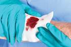 High-tech wound dressing is shown to fight infection High-tech wound dressing is shown to fight infection