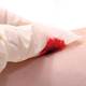 Study finds that frequent debridement speeds healing Study finds that frequent debridement speeds healing