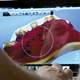 3-D technology may hasten denture sizing for residents 3-D technology may hasten denture sizing for residents