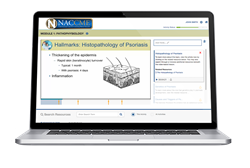 New online education series on psoriasis launched New online education series on psoriasis launched