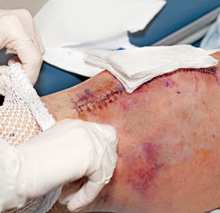 Lower implant prices and closer scrutiny of post-acute care drove joint replacement surgery costs. Lower implant prices and closer scrutiny of post-acute care drove joint replacement surgery costs.