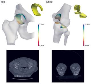 The system could give better understanding of treating arthritic joints The system could give better understanding of treating arthritic joints