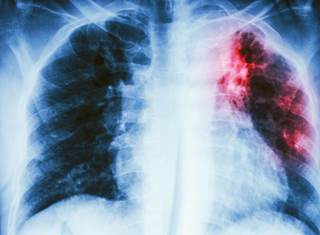 Tuberculosis can be inhaled into the lungs when someone nearby with the disease coughs, sneezes, sings or laughs, according to health officials. Tuberculosis can be inhaled into the lungs when someone nearby with the disease coughs, sneezes, sings or laughs, according to health officials.